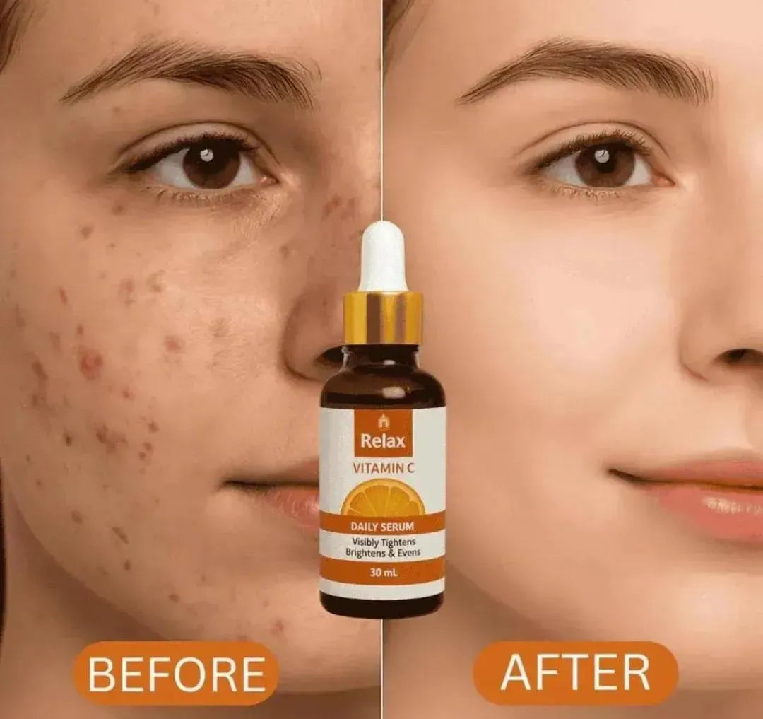 Vitamin C Serum for Brightening & Acne Removal